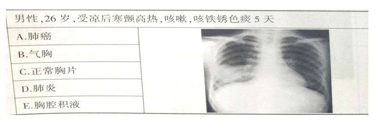 肺炎