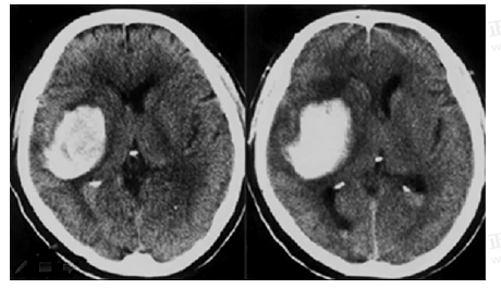 男55歲，左側(cè)肢體偏癱4小時(shí)，有高血壓史，診斷為